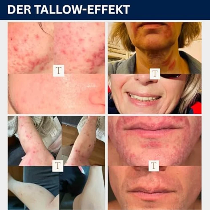 Tallow TALLOW ORIGINAL BALM NATUR, 100% Bio Rindertalg Creme für Hautpflege, 120ml, aus grasgefütterten Rindern vom Bodensee, natürliche Feuchtigkeitscreme reich an Vitaminen und Fettsäuren – Bild 4
