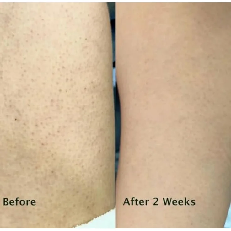 Australian Bodycare Salicylic Acid Keratosis Wash, Duschgel für Unisex mit Peeling-Effekt, 200 ml – Bild 6