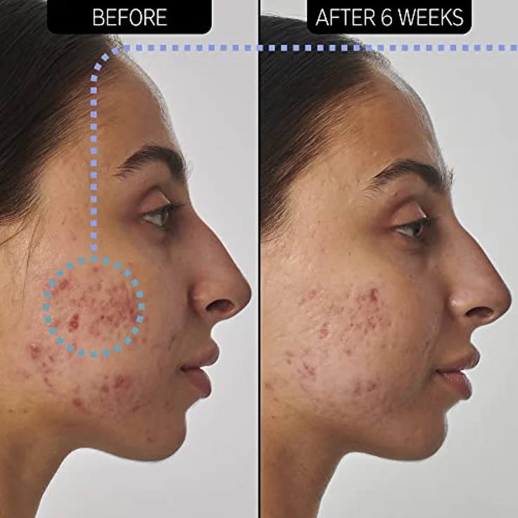 The INKEY List Retinol 1% Serum Supersolutions 30ml, Narben-, Flecken- und Faltenlösung, mit 1% Retinol, Aprikosenkernöl und Squalan – Bild 4