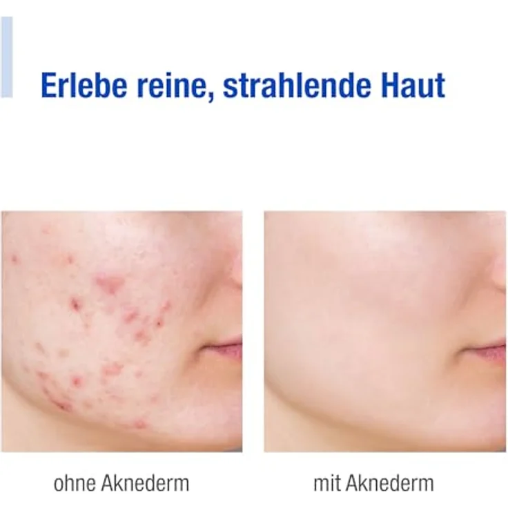 Aknederm Aknederm Tinktur sensitiv Anti-Akne 100 ml – Bild 5