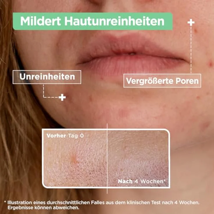 Mixa Anti-Unreinheiten Serum, Für zu Akne neigende und sensible Haut, Mattes Finish & Ölkontrolle, 30 ml – Bild 3