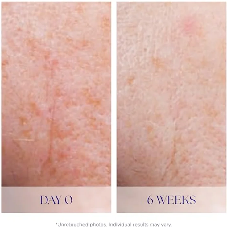 iS Clinical Active Serum 30 ml, Gesichtsserum zur Reduzierung feiner Linien, Falten und Akne-Behandlung, für alle Hauttypen – Bild 5