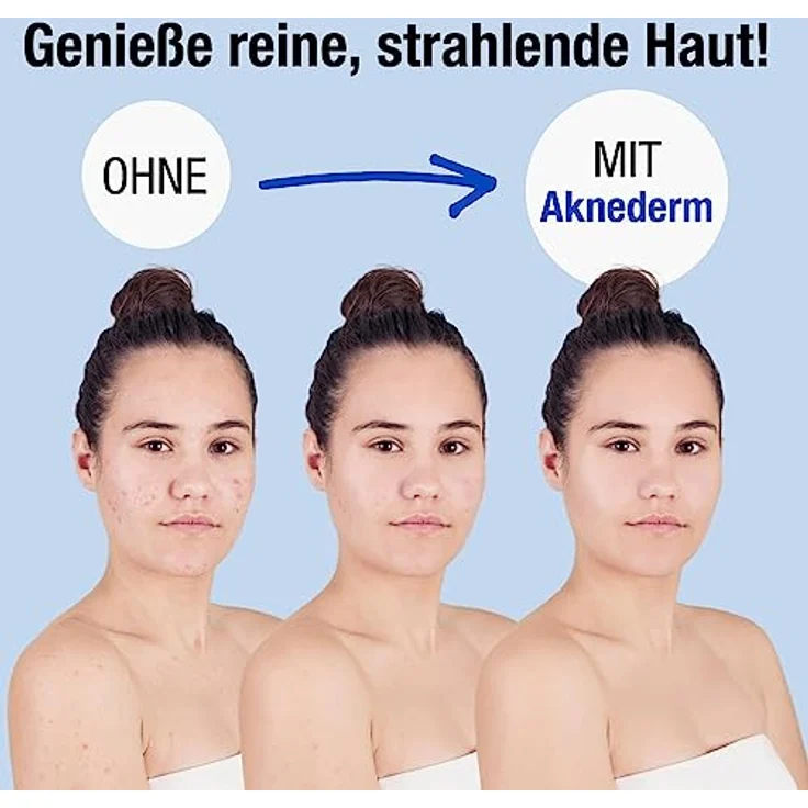 AKNEDERM mattierende Gesichtslotion gegen Pickel & Akne 2 x 30ml - Tageslotion für normale bis fettige & unreine Haut - Creme für fettige Haut, wirkt antibakteriell & reguliert Talg – Bild 3