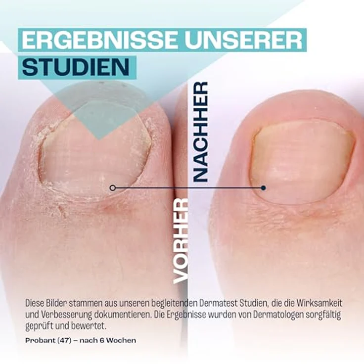 GOaktiv® NAGELNEU, Pflegendes Nagelgel zur Intensivpflege geschwächter Nägel und Unterstützung bei Nagelpilz, 10 ml, medizinische Formel mit Urea und Dexpanthenol – Bild 4