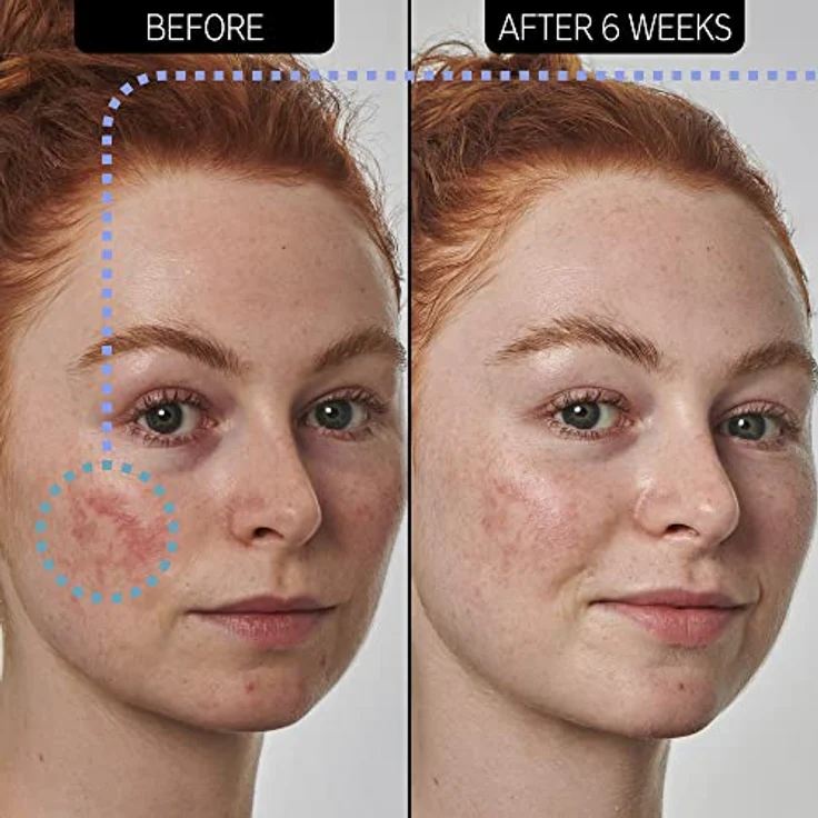 The INKEY List | Azelaic Acid 10% Serum | Redness Relief Solution | 30ml – Bild 4