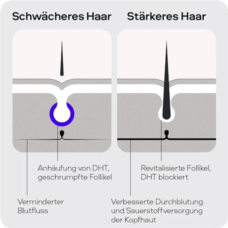 Sons Minoxidil 5% Lösung mit Derma Roller für Männer, fördert Haarwachstum und -dichte, 60 ml – Bild 2