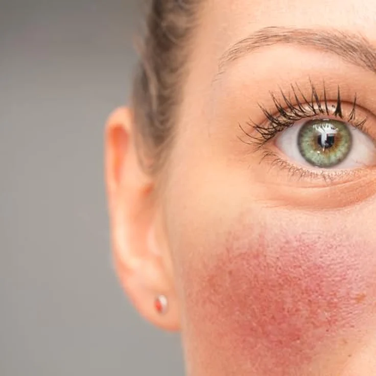Prontomed Sanaveo Couperose Creme 50ml - Beruhigender Balsam für empfindliche Haut mit 7-Kräuter-Komplex zur Reduktion von Rötungen und sichtbaren Äderchen – Bild 3