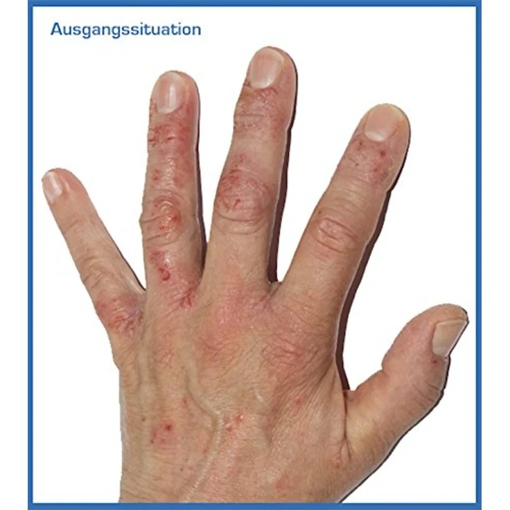 Prontomed SoleaDerm Creme 100ml | bei Neurodermitis & Psoriasis | mit Reiskeimöl & 5% Urea, dermatologisch getestet – Bild 2