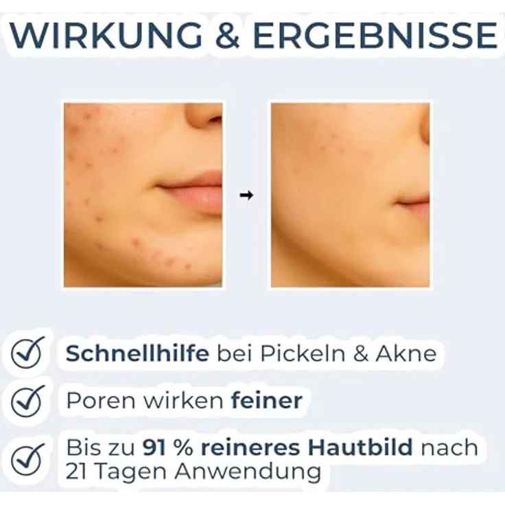 VIGOROUS® Zink Gesichtswasser 120ml, Anti-Pickel Gesichtsreinigung mit Salicylsäure & Niacinamid, Vegan gegen hormonelle Akne, für Männer & Frauen – Bild 2