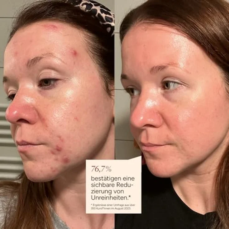 JUNGLÜCK Azelain Serum, Vegan Gesichtsserum mit 10% Azelaic Acid, beruhigend gegen Pickel & Rötungen, mattiert öligen Glanz, für empfindliche und unreine Haut – Bild 2