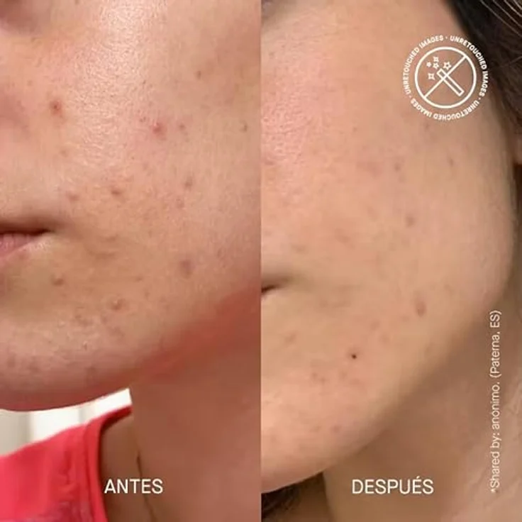 Transparent Lab PIE Acne Red Spot Fading Treatment, 30 ml zur gezielten Behandlung von roten Pickelmalen – Bild 7