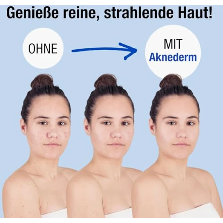 AKNEDERM mattierende Gesichtslotion gegen Pickel & Akne 30ml - Tageslotion für fettige Haut, wirkt antibakteriell & reguliert Talg – Bild 3