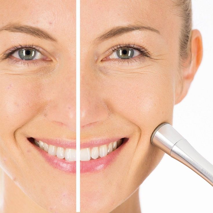 Beurer FC 100 Mikrodermabrasionsgerät, Gesichtspeeling mit Anti Aging Wirkung und Unterdruckmassage, Gesichtsreinigung für zuhause – Bild 2