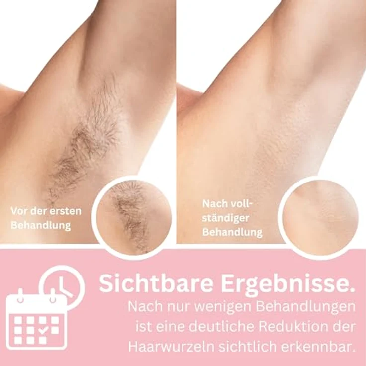 Removely IPL 5plus Laser Haarentfernung Gerät, effektives IPL-Gerät für dauerhafte Haarentfernung, mit intelligentem Hautsensor und automatischer Blitzauslösung, für Frauen & Männer – Bild 4