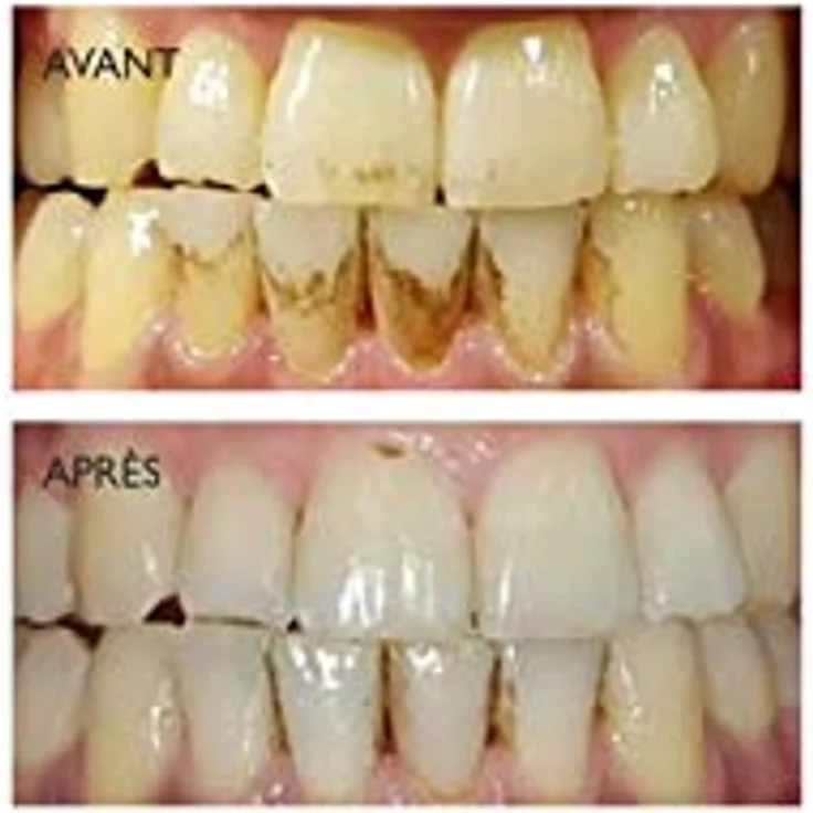 Silk'n ToothWave Hochfrequenz-Zahnbürste mit 4 Intensitätsstufen und 3 Wochen Akkulaufzeit – Bild 4